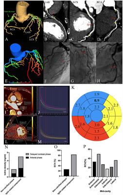 Case Report: Dual-Energy Computed Tomography of Cardiac Changes in IgG4-Related Disease